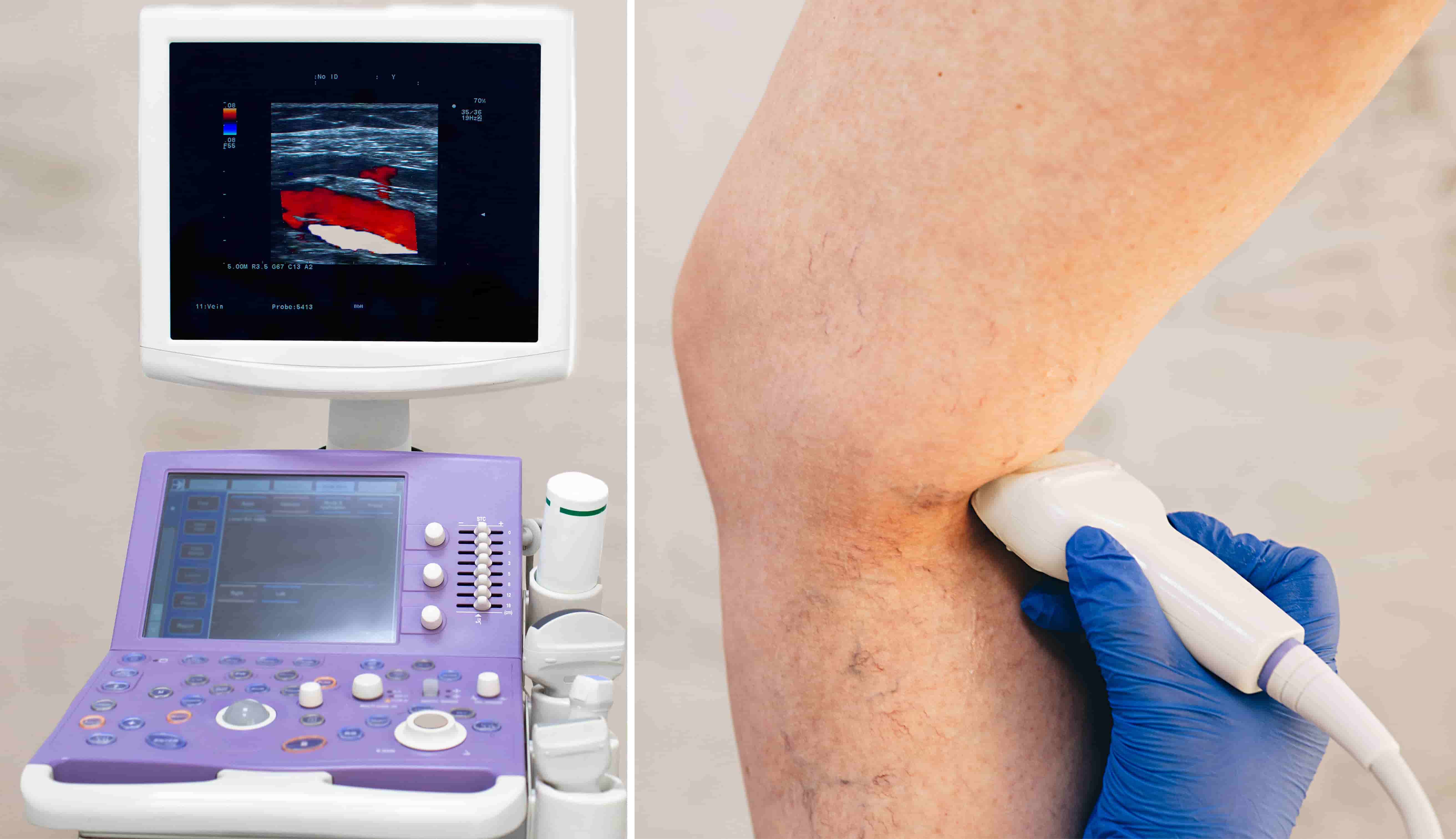 Traitement des varices en médecine esthétique méthodes et résultats